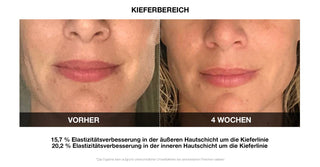 Vilifti verjüngende Maske mit elektrischer Muskelstimulation EMS Maske FACEGYM Medi Lift